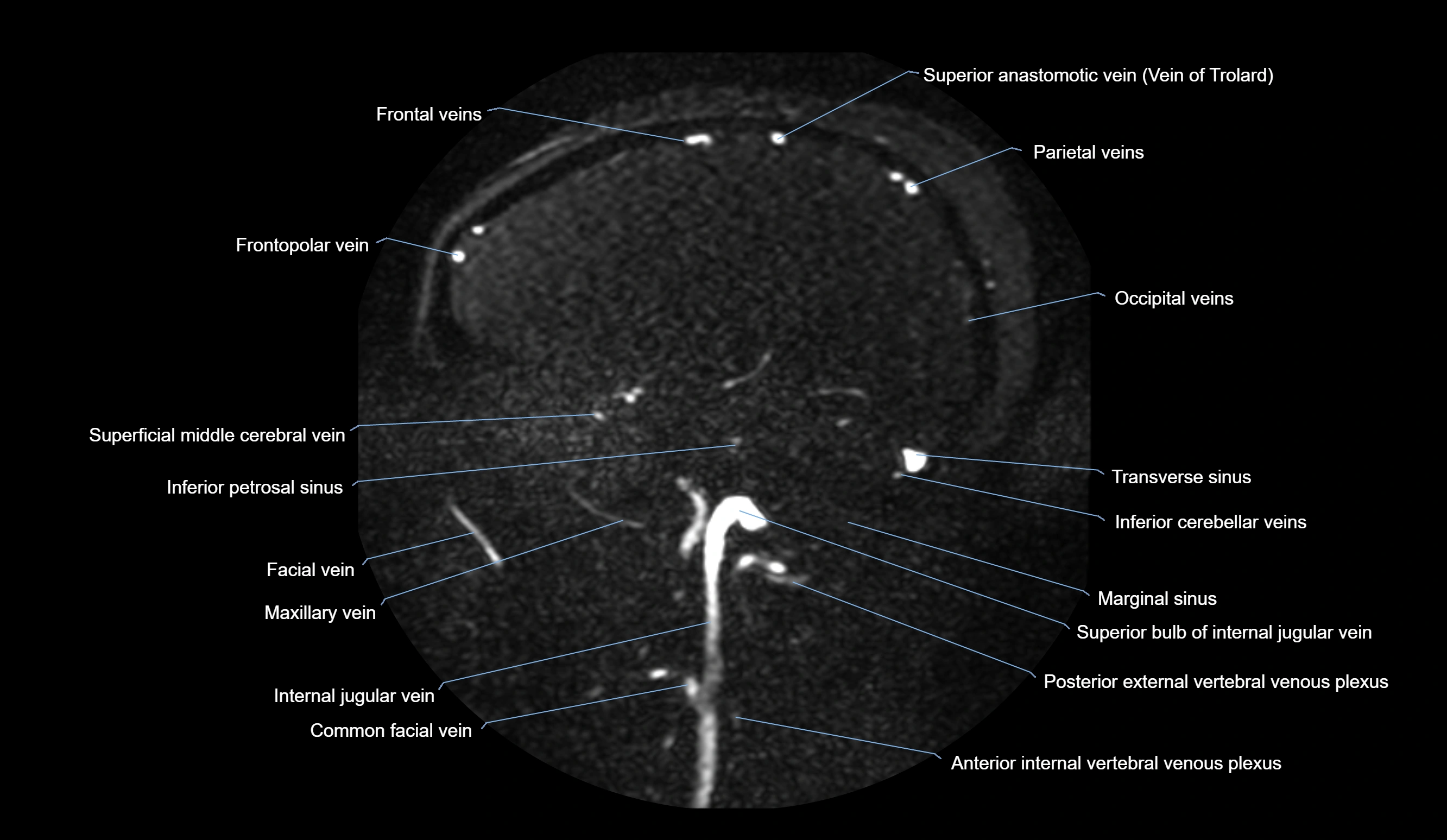 MRV brain sagittal anatomy 3T MRI images -img-01015-00056.webp